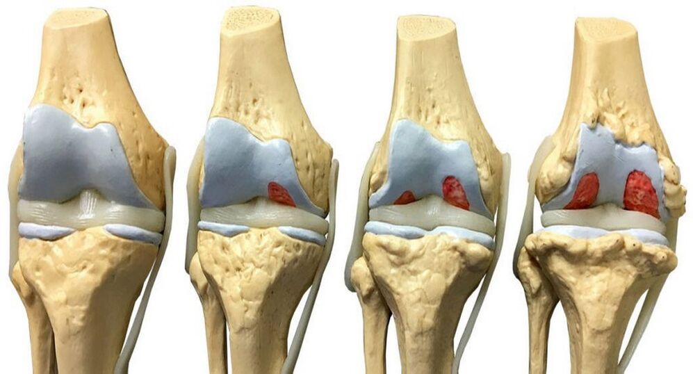 Arthrosis fir mat Hondrofrost behandelt ze ginn