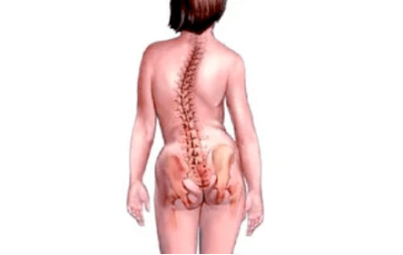 Grënn fir d'Entwécklung vun cervical osteochondrosis