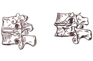 Zänn vun der Entwécklung vun thomacen Osteochondrosis