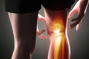 Zerstéierung vum Knéi Gelenk als Konsequenz vum Arthrosis