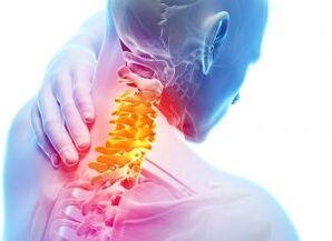 Péng a Schéissen am Gebärmutterhalsgebitt mat Drëttgrad Osteochondrose