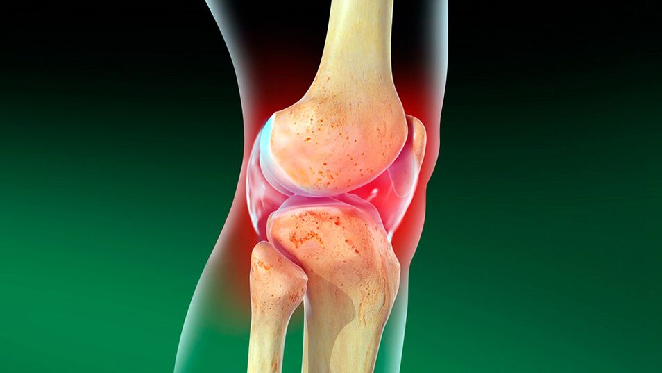 Osteoarthritis vum Kniegelenk