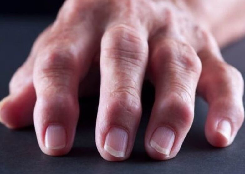 rheumatoid Arthritis als Ursaach vu Péng an de Gelenker vun de Fanger