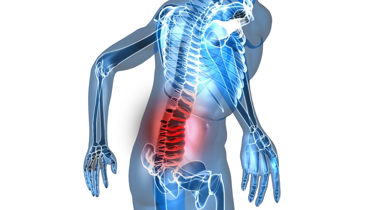 Osteochondrose vun der Lendegéigend