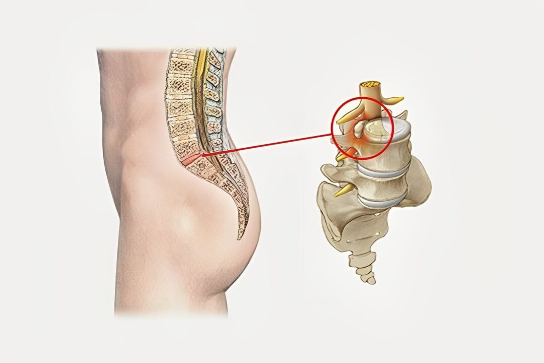 disc Deformatioun an der sakral Wirbelsäule