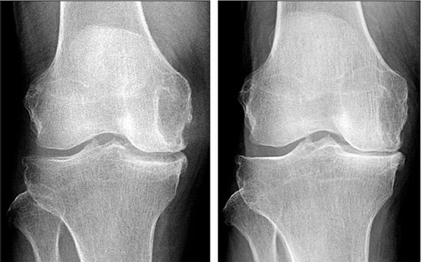 virun an no der Arthrosis Behandlung mat Hondrofrost